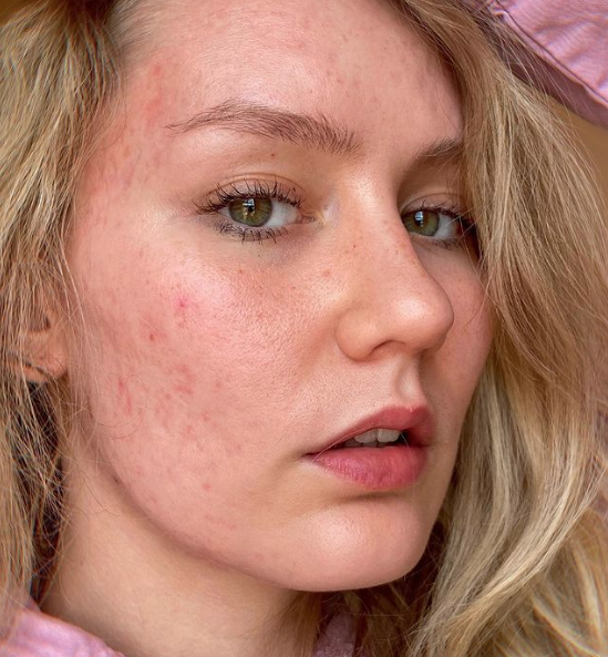 girl with textured skin and acne scarring, highlighting the acne positivity movement